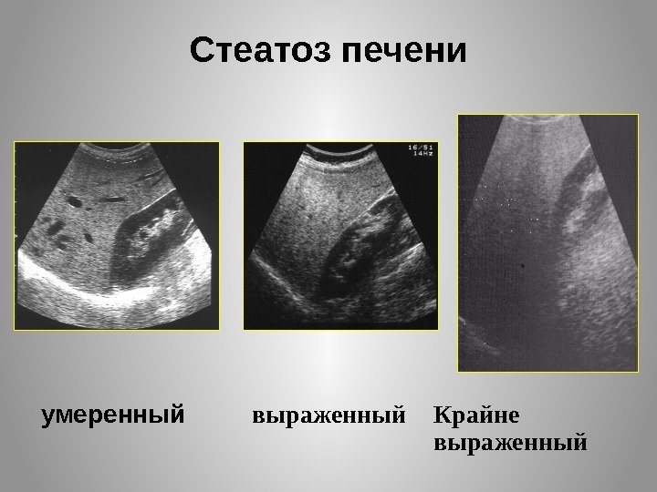 Стеатоз печени умеренный Крайне выраженный 