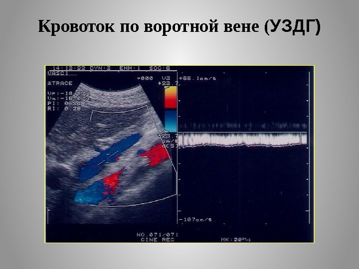 Кровоток по воротной вене ( УЗДГ) 