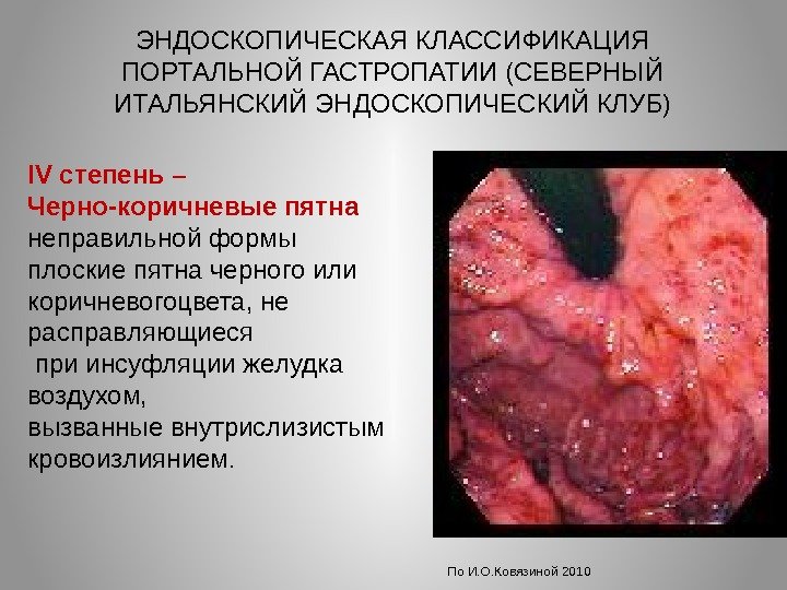 ЭНДОСКОПИЧЕСКАЯ КЛАССИФИКАЦИЯ ПОРТАЛЬНОЙ ГАСТРОПАТИИ (СЕВЕРНЫЙ ИТАЛЬЯНСКИЙ ЭНДОСКОПИЧЕСКИЙ КЛУБ) По И. О. Ковязиной 2010 IV