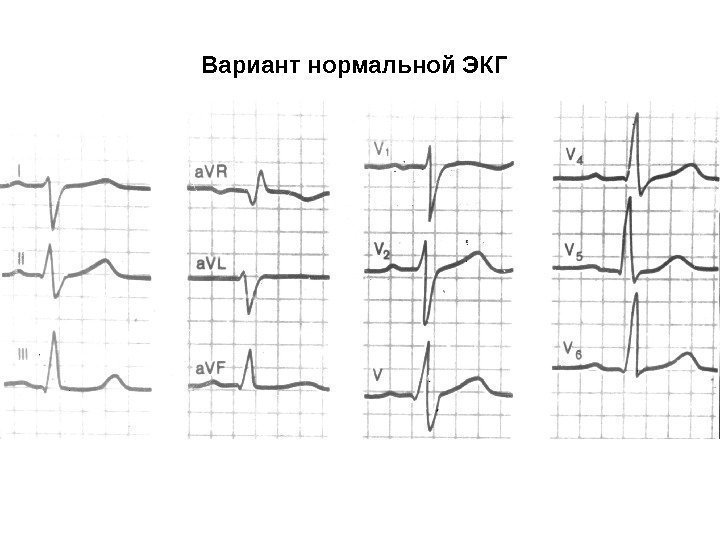 Вариант нормальной ЭКГ 