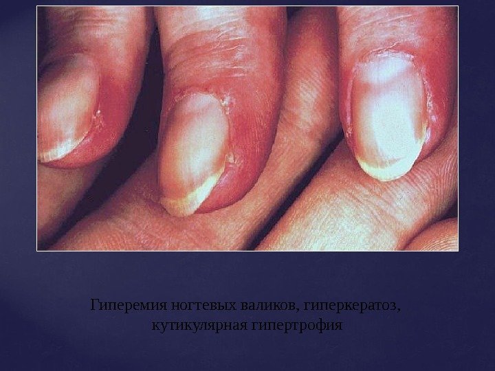 Гиперемия ногтевых валиков, гиперкератоз,  кутикулярная гипертрофия 