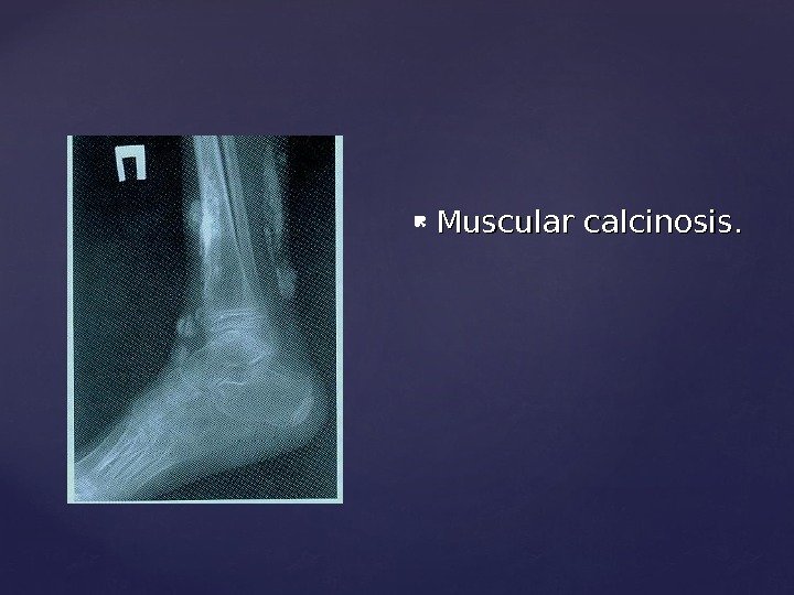  Muscular calcinosis. 