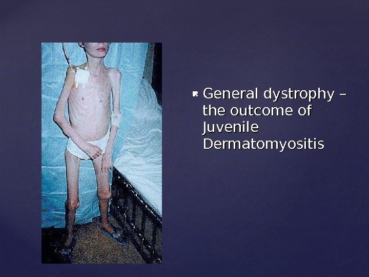 General dystrophy – the outcome of Juvenile Dermatomyositis 
