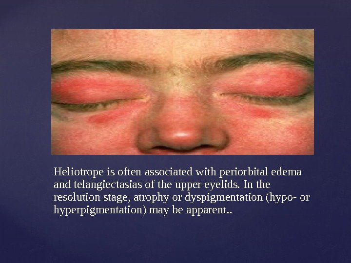 Heliotrope is often associated with periorbital edema and telangiectasias of the upper eyelids. In