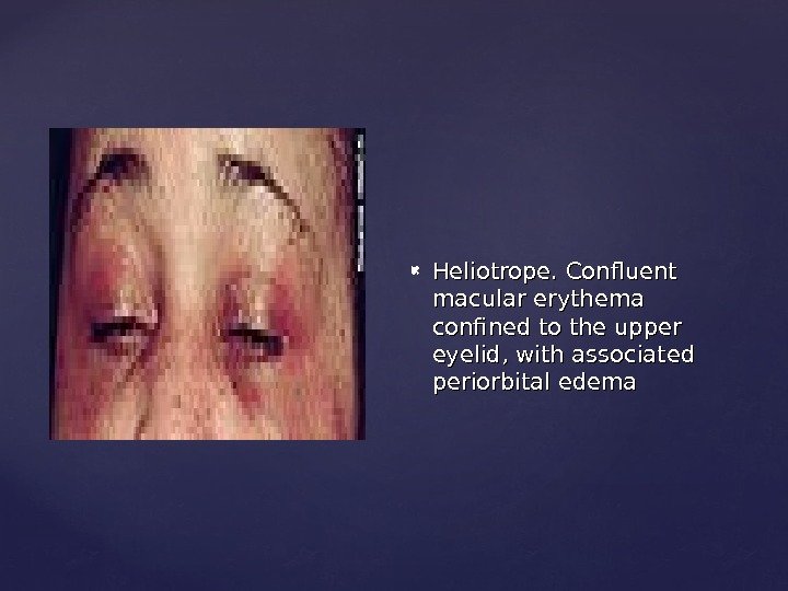  Heliotrope. Confluent macular erythema confined to the upper eyelid, with associated periorbital edema