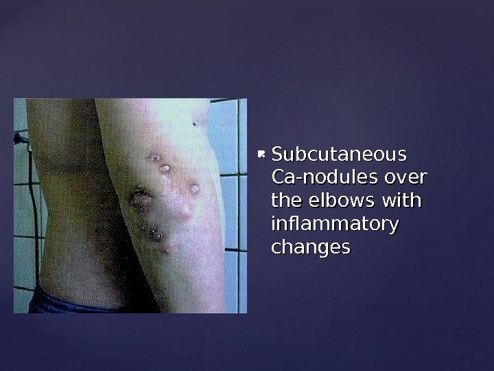  Subcutaneous Ca-nodules over the elbows with inflammatory changes 