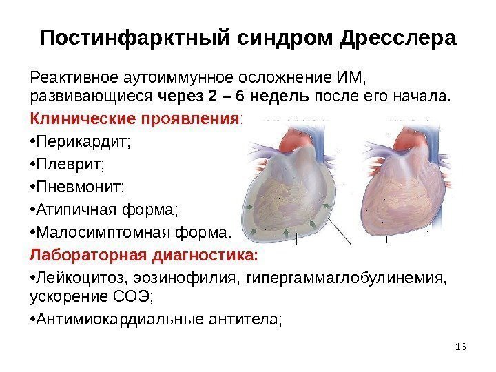 16 Постинфарктный синдром Дресслера Реактивное аутоиммунное осложнение ИМ,  развивающиеся через 2 – 6