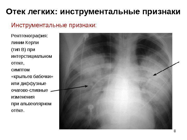 Отек легких: инструментальные признаки Инструментальные признаки: Рентгенография:  линии Керли (тип В) при интерстициальном