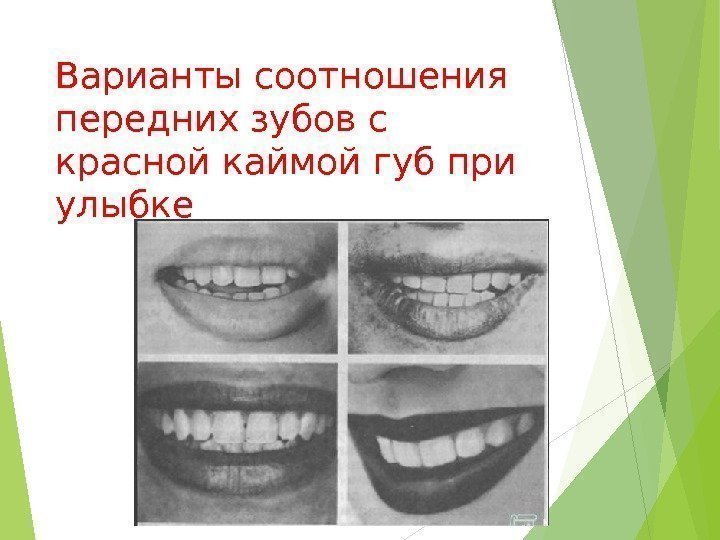 Варианты соотношения передних зубов с красной каймой губ при улыбке   