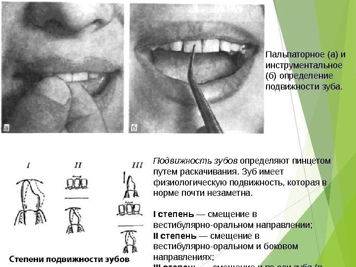 Пальпаторное (а) и инструментальное (б) определение подвижности зуба. Подвижность зубов определяют пинцетом путем раскачивания.