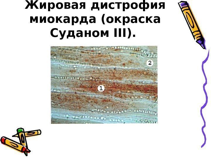   Жировая дистрофия миокарда (окраска Суданом III ).  