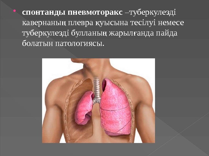  спонтанды пневмоторакс –туберкулезді кавернаны плевра уысына тесілуі немесе ң қ туберкулезді булланы жарыл