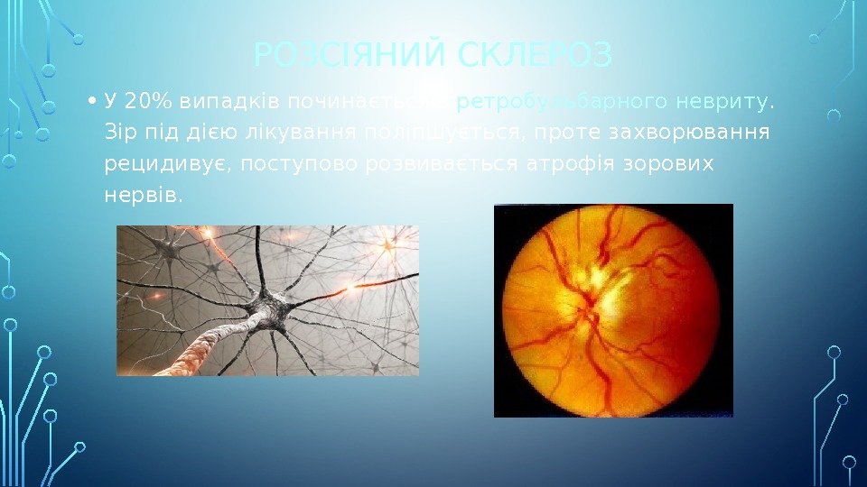 РОЗСІЯНИЙ СКЛЕРОЗ • У 20 випадків починається з ретробульбарного невриту.  Зір під дією