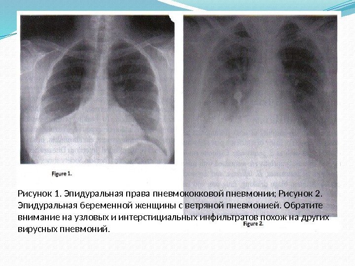 Рисунок 1. Эпидуральная права пневмококковой пневмонии; Рисунок 2.  Эпидуральная беременной женщины с ветряной