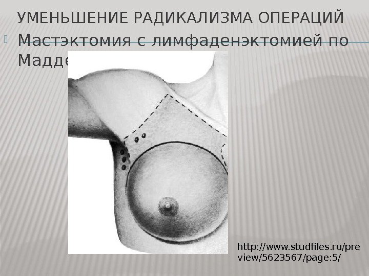 УМЕНЬШЕНИЕ РАДИКАЛИЗМА ОПЕРАЦИЙ Мастэктомия с лимфаденэктомией по Маддену http: //www. studfiles. ru/pre view/5623567/page: 5/