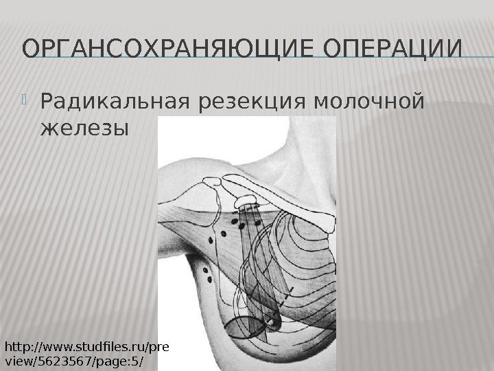 ОРГАНСОХРАНЯЮЩИЕ ОПЕРАЦИИ Радикальная резекция молочной железы http: //www. studfiles. ru/pre view/5623567/page: 5/ 