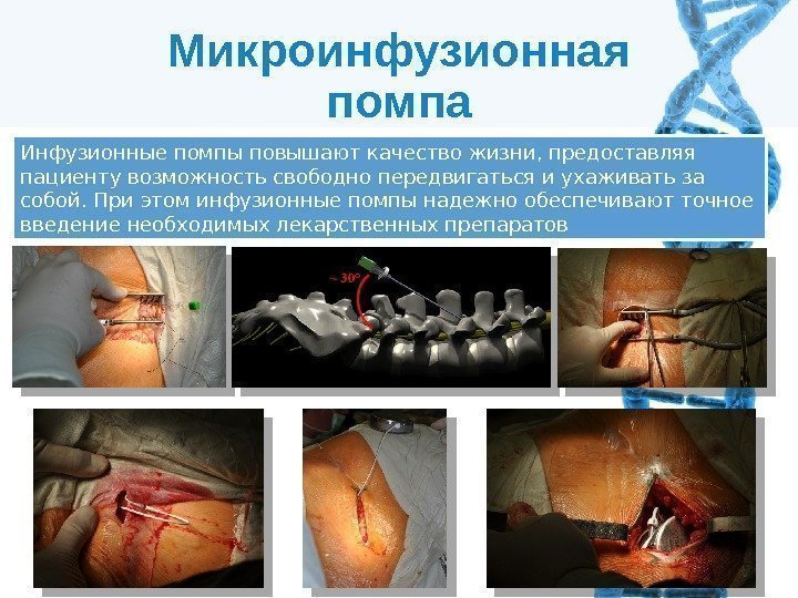 Микроинфузионная помпа Инфузионные помпы повышают качество жизни, предоставляя пациенту возможность свободно передвигаться и ухаживать