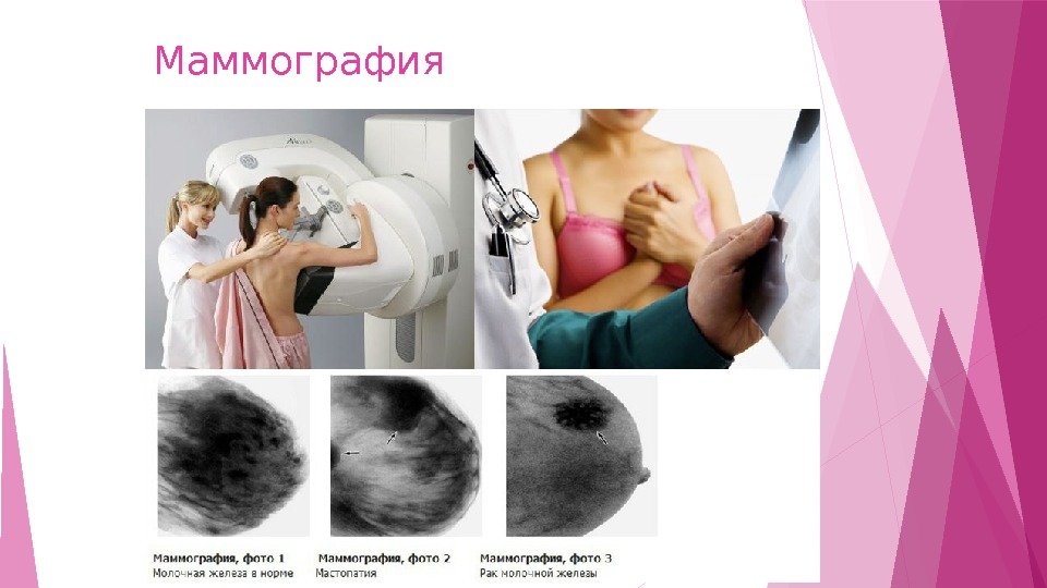 Маммография    