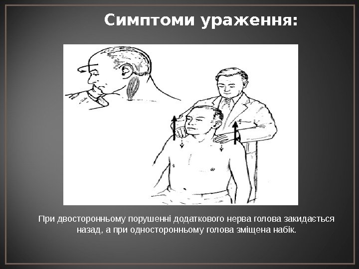 Симптоми ураження: При двосторонньому порушенні додаткового нерва голова закидається назад, а при односторонньому голова