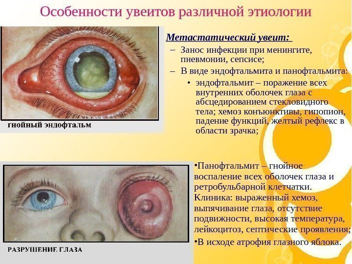   • Метастатический увеит:  – Занос инфекции при менингите,  пневмонии, сепсисе;