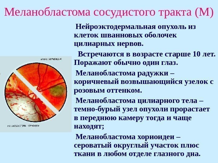   Меланобластома сосудистого тракта (М)  Нейроэктодермальная опухоль из клеток шванновых оболочек цилиарных