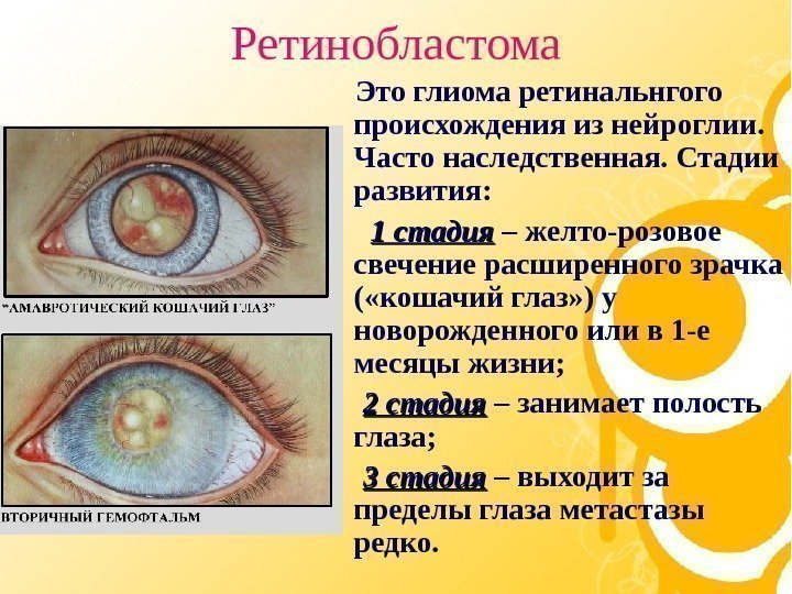   Ретинобластома Это глиома ретинальнгого происхождения из нейроглии.  Часто наследственная. Стадии развития: