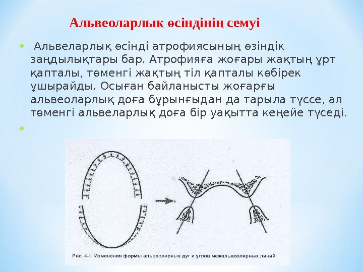  •  Альвеларлық өсінді атрофиясының өзіндік заңдылықтары бар. Атрофияға жоғары жақтың ұрт қапталы,