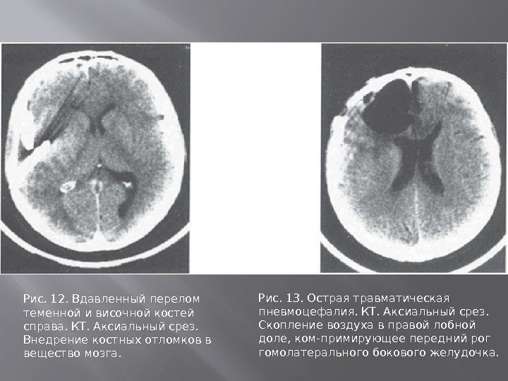 Рис. 12. Вдавленный перелом теменной и височной костей справа. КТ. Аксиальный срез.  Внедрение