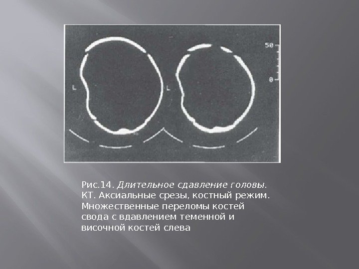 Рис. 14.  Длительное сдавление головы.  КТ. Аксиальные срезы, костный режим.  Множественные