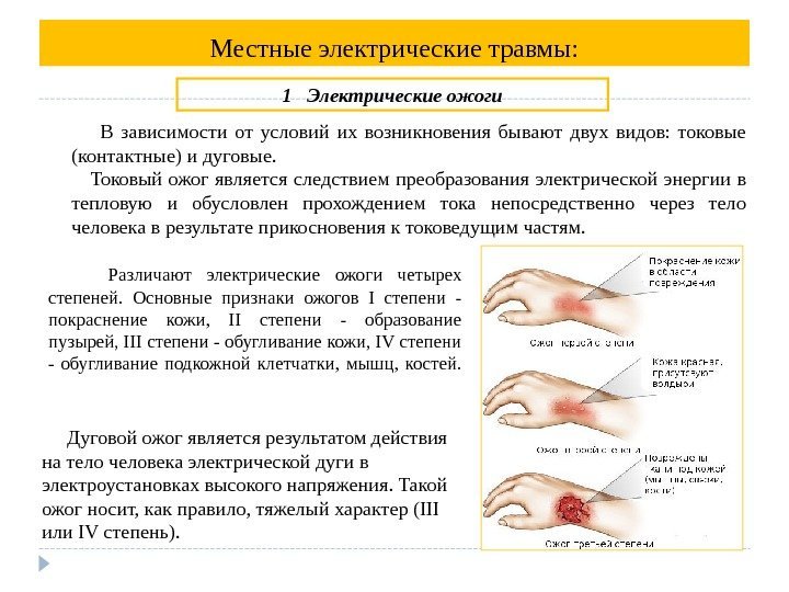 Местные электрические травмы:   Различают электрические ожоги четырех степеней.  Основные признаки ожогов