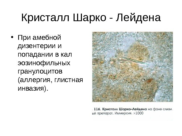 Кристалл Шарко - Лейдена • При амебной дизентерии и попадании в кал эозинофильных гранулоцитов