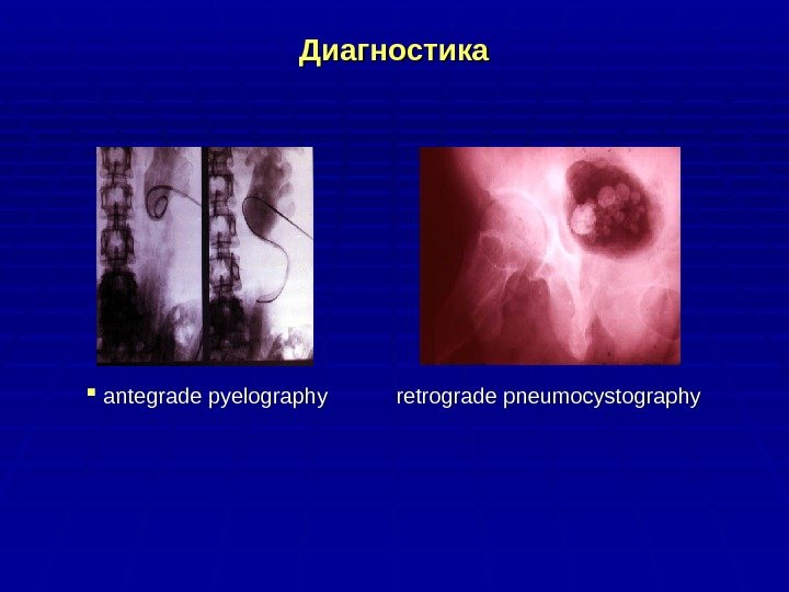 Диагностика antegrade pyelography  retrograde pneumocystography 