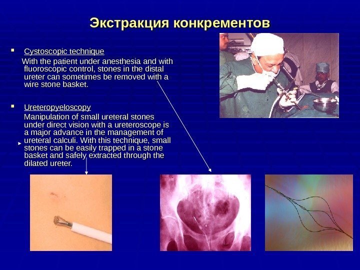 Экстракция конкрементов Cystoscopic technique    With the patient under anesthesia and with