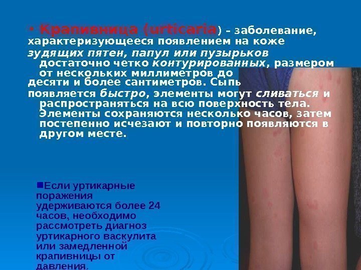  • Крапивница (urticaria ) – заболевание, характеризующееся появлением на коже зудящих пятен, папул