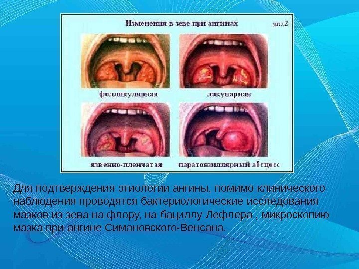 Для подтверждения этиологии ангины, помимо клинического наблюдения проводятся бактериологические исследования мазков из зева на