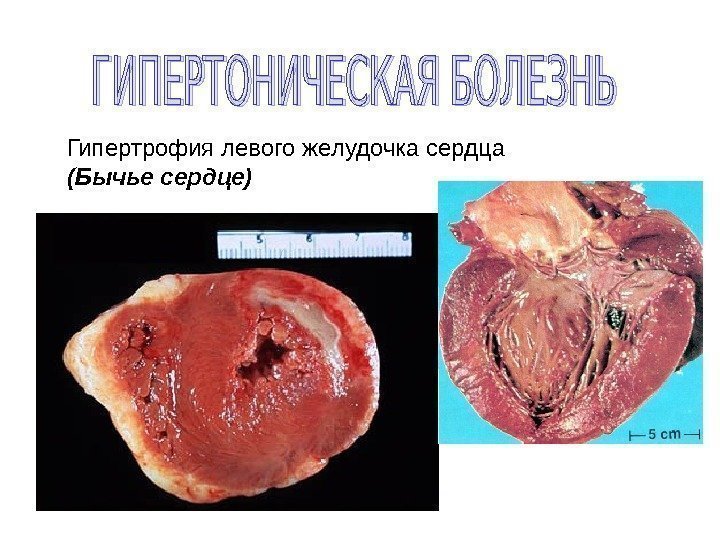 Гипертрофия левого желудочка сердца (Бычье сердце)  