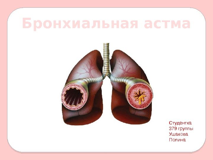 Бронхиальная астма Студентка 379 группы Ушакова Полина 