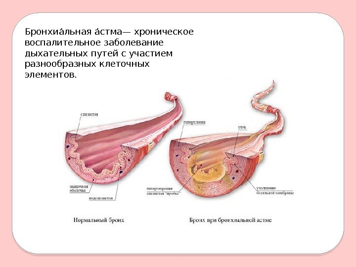 Бронхиаальная аастма— хроническое воспалительное заболевание дыхательных путей с участием разнообразных клеточных элементов.  