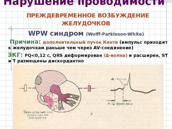 Нарушение проводимости  ПРЕЖДЕВРЕМЕННОЕ ВОЗБУЖДЕНИЕ ЖЕЛУДОЧКОВ WPW синдром ( Wolff-Parkinson-White ) Причина:  дополнительный