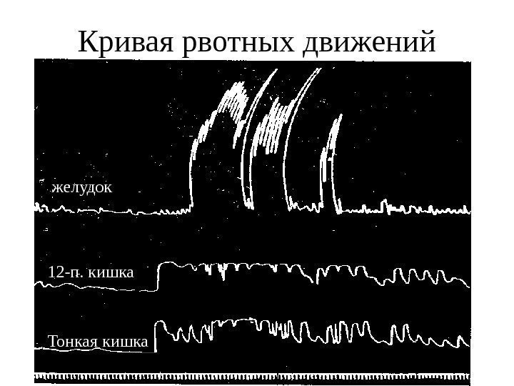 Кривая рвотных движений желудок 12 -п. кишка Тонкая кишка 