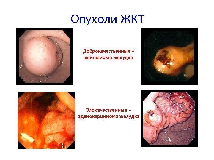 Опухоли ЖКТ Доброкачественные – лейомиома желудка Злокачественные – аденокарцинома желудка 