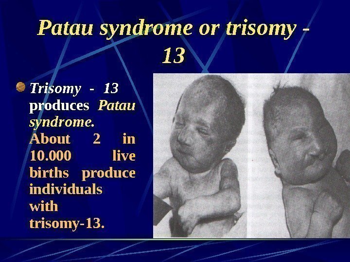   Patau syndrome or trisomy - 13 Trisomy - 13  produces Patau