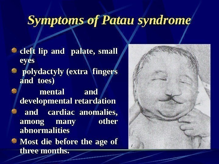   Symptoms of Patau syndrome cleft lip and  palate,  small eyes