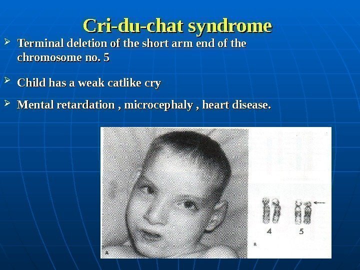  Cri-du-chat syndrome Terminal deletion of the short arm end of the chromosome no.