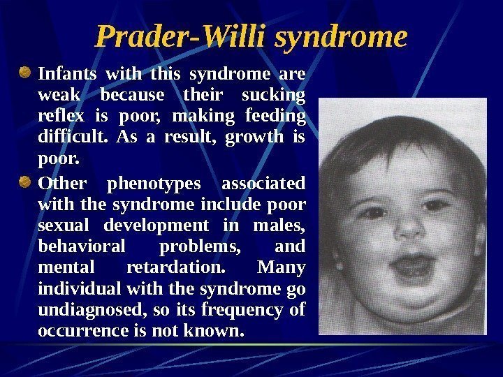   Prader-Willi syndrome Infants with this syndrome are weak because their sucking reflex
