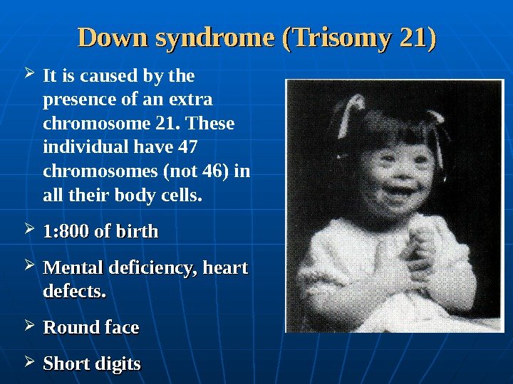  Down syndrome (Trisomy 21) It is caused by the presence of an extra