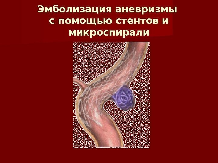 Эмболизация аневризмы с помощью стентов и микроспирали 
