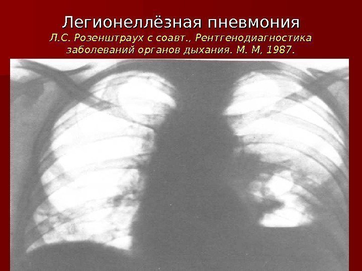 Легионеллёзная пневмония Л. С. Розенштраух с соавт. , Рентгенодиагностика заболеваний органов дыхания. М. М,