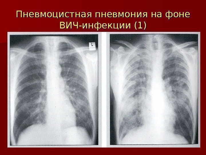 Пневмоцистная пневмония  на фоне ВИЧ-инфекции (1) 