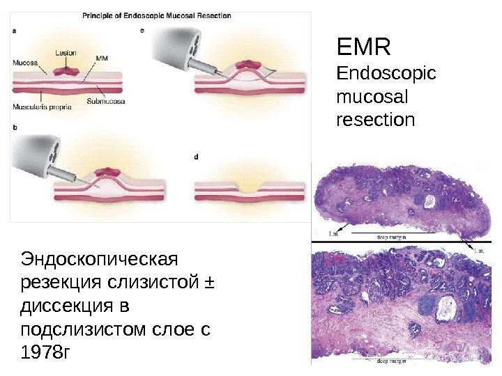 EMR Endoscopic mucosal resection  Эндоскопическая резекция слизистой ±  диссекция в подслизистом слое